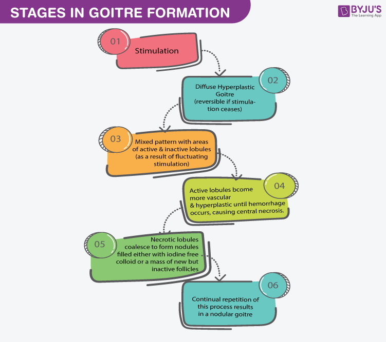 Stages in Goitre formation