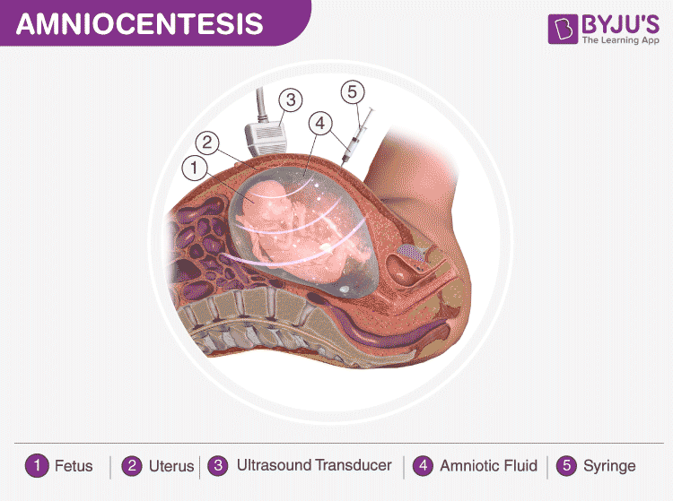 amniocentesis diagram