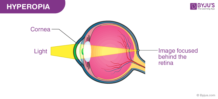 genetikai betegség myopia