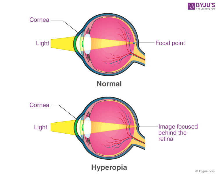 Eye Defects Types Examples Definition Hypermetropia Treatment