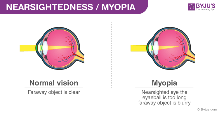 Myopia Causes Symptoms Formula And Nearsightedness 9676