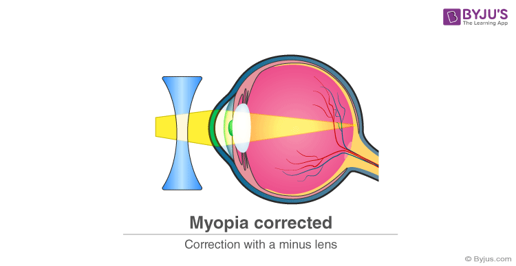 Is Nearsightedness Due to the Eyeball Being Too Long?