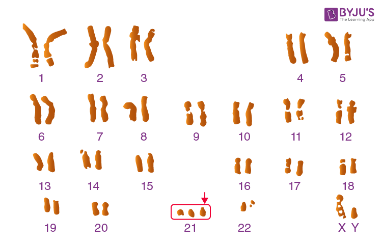 Down’s syndrome (Trisomy of Chromosome 21)