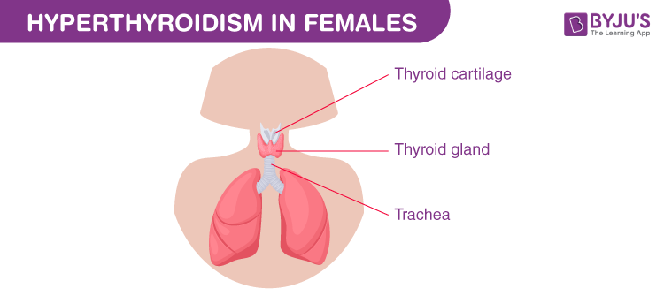 Hyperthyroidism in Females