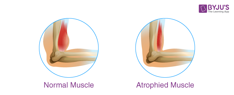 Types of Muscular Dystrophy