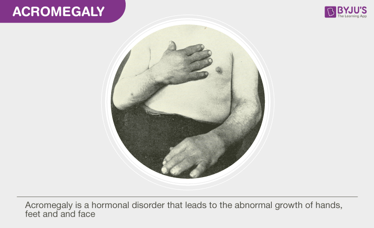 Acromegaly