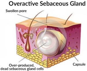 The case of an overactive sebaceous gland