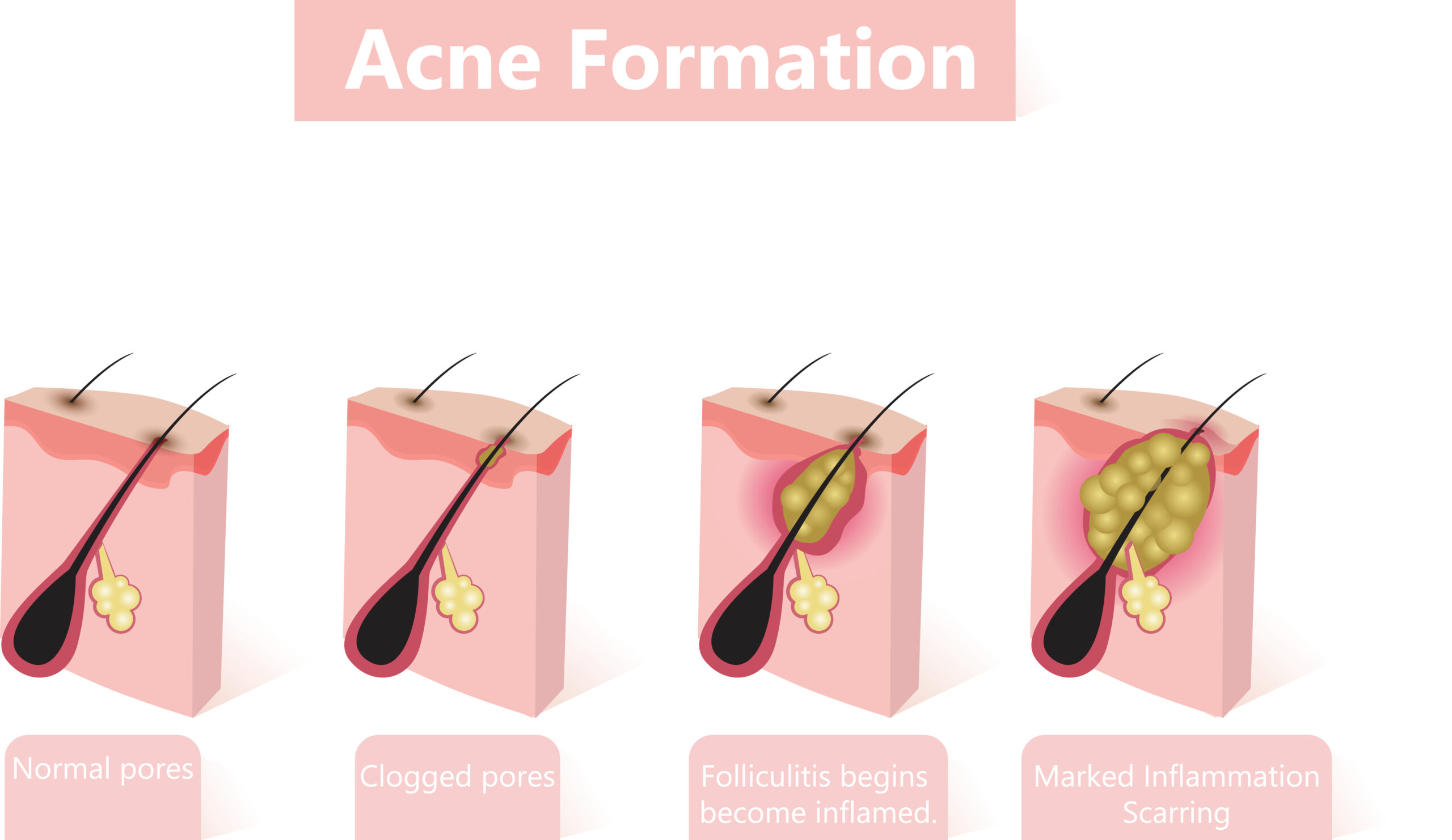 Stages of acne formation